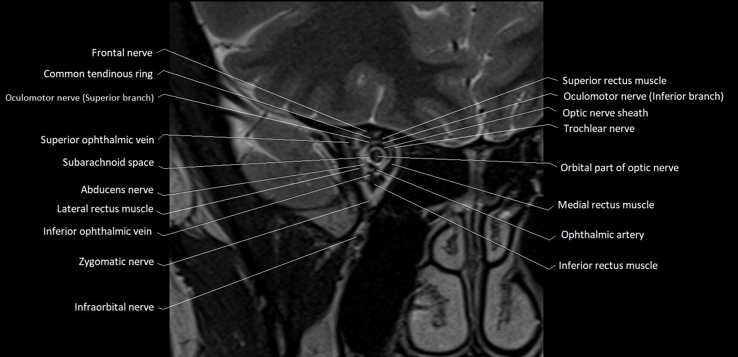 MRI Orbit coronal cross sectional anatomy image 13.webp